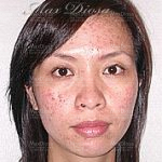 個案1：Karen 治療前