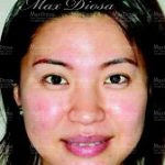 個案4：Mrs Lau 治療中