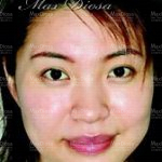 個案4：Mrs Lau 治療後