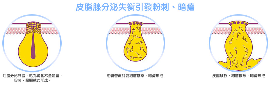 由於皮脂腺分泌旺盛,造成角化不全、而玫使毛孔口阻塞,然而皮脂腺繼續不斷不分泌油脂,致使皮脂管過度膨脹而破裂,皮脂內的游離酸、角質蛋白、細菌、皮膚屑的殘餘物往真皮溢,出形成紅腫,炎症、暗瘡。 由於皮脂腺分泌旺盛,造成角化不全、而玫使毛孔口阻塞,然而皮脂腺繼續不斷不分泌油脂,致使皮脂管過度膨脹而破裂,皮脂內的游離酸、角質蛋白、細菌、皮膚屑的殘餘物往真皮溢,出形成紅腫,炎症、暗瘡。